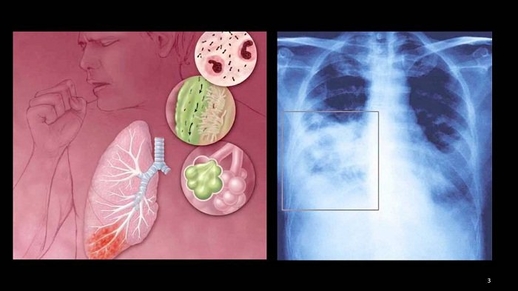Virus RS và việc bảo vệ trẻ sinh non