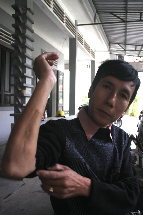 Những ngày trở gió, vết thương ở tay cựu binh Trần Thiện Phụng lại nhức mỏi không nguôi